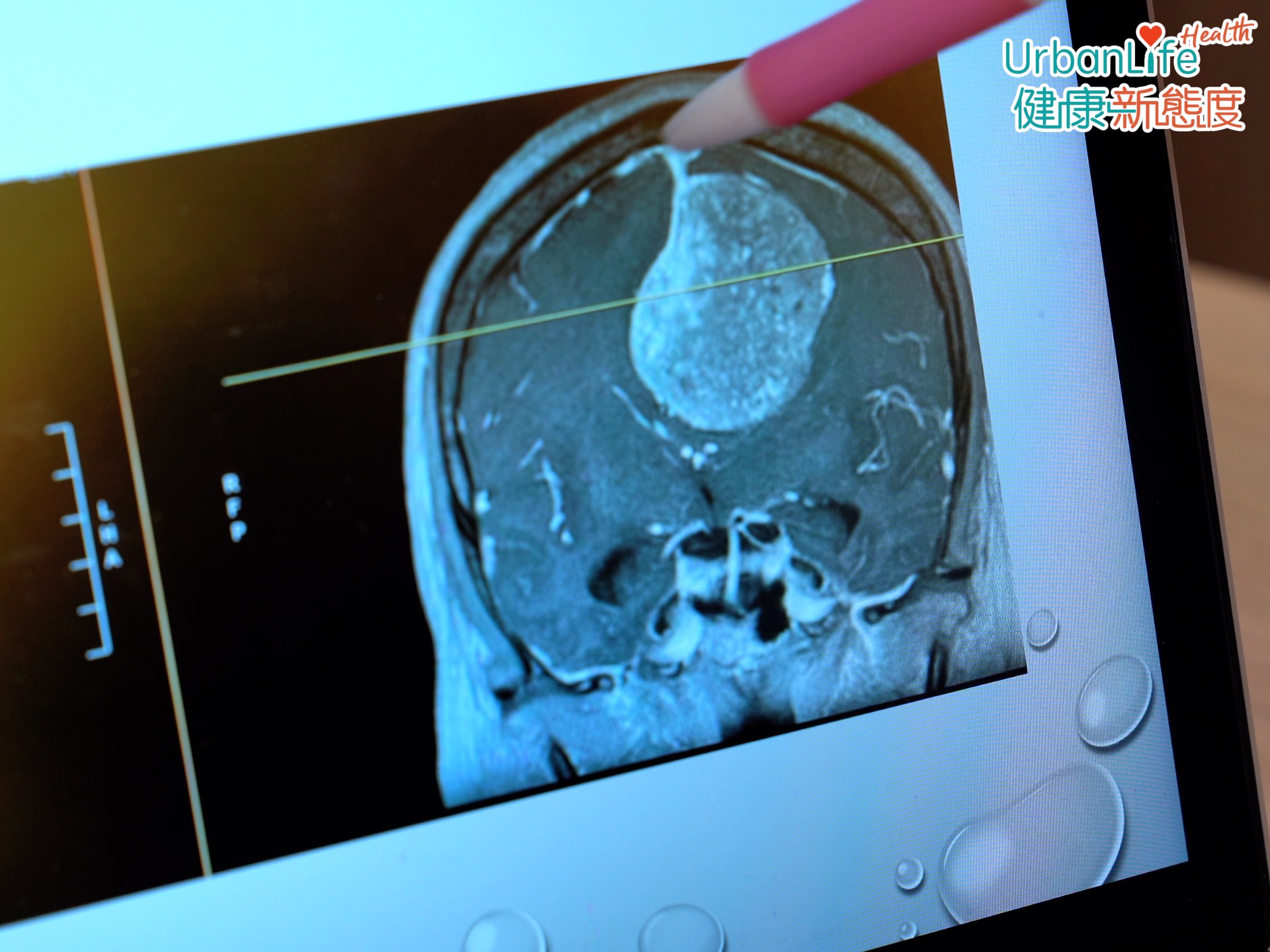 如果出現持續頭痛、頭暈,甚至作嘔作悶、走路都有困難,就要小心可能是患上腦膜瘤。