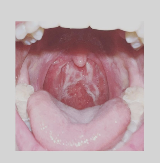 林欣彤染新冠肺炎，她指喉嚨痛到每秒也在崩潰。