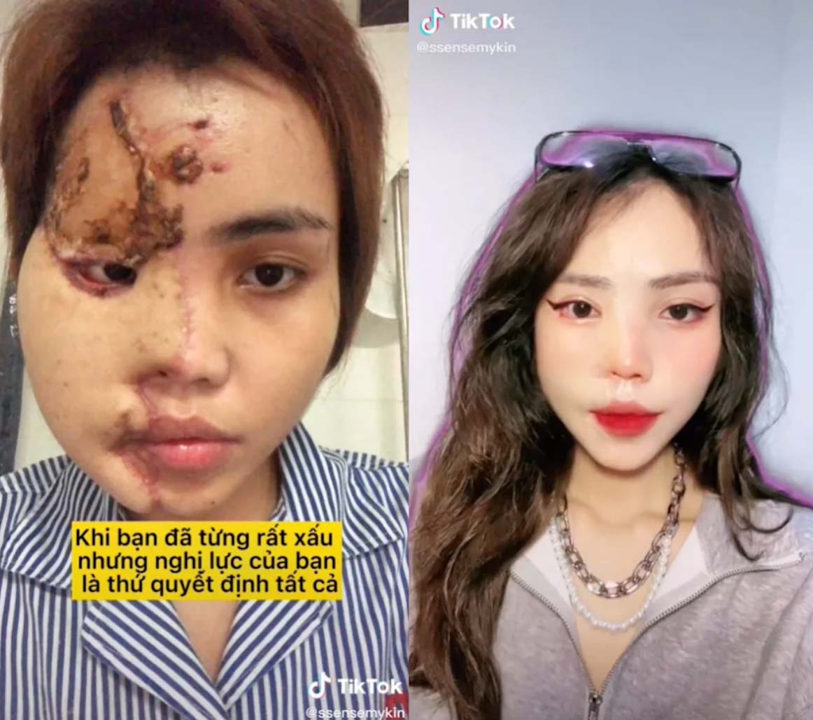 Le Lan Vy臉部有49%皮膚受損、半邊臉潰爛毀容