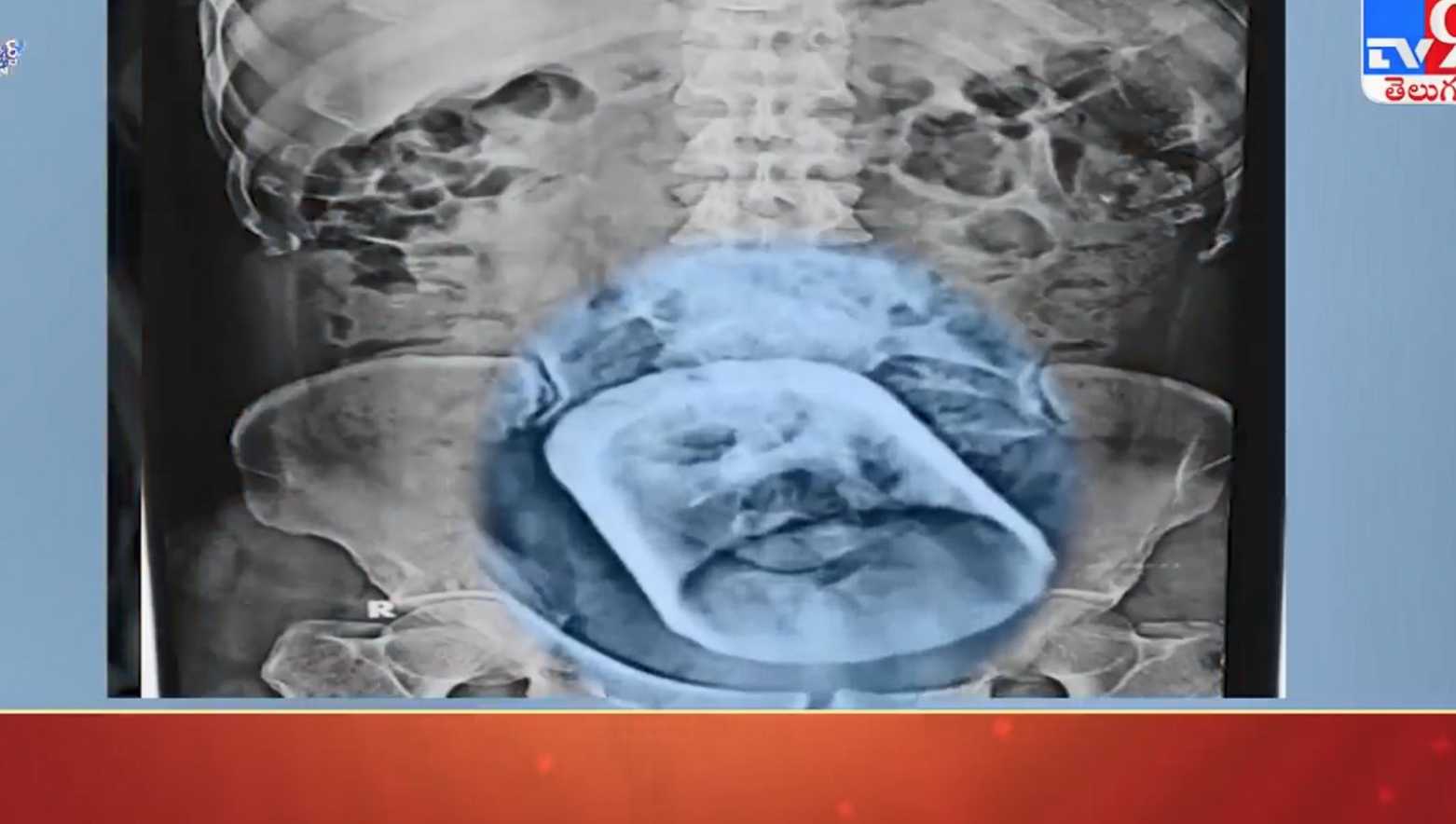 印度早前就發生一宗類似的離奇「吞杯事故」。