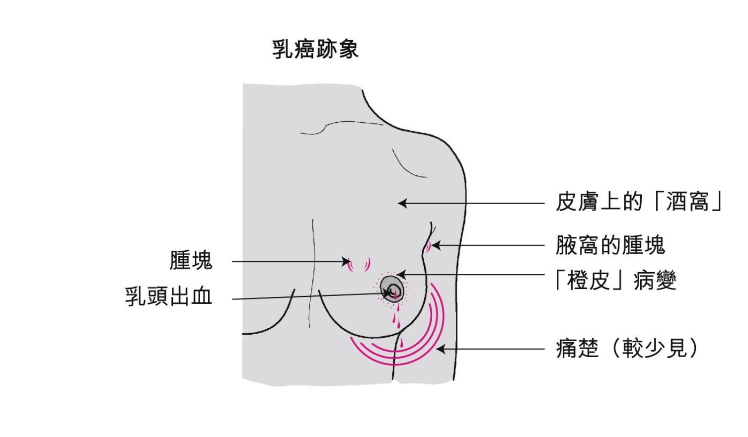 如果你乳房大小或形狀有所改變,你可能已患上乳癌。