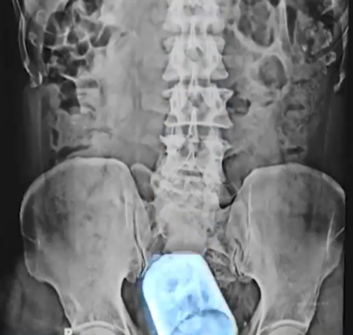 主診外科醫生Mahmudul Hasan表示，從X光片所見，杯子可能比拳頭還要大。