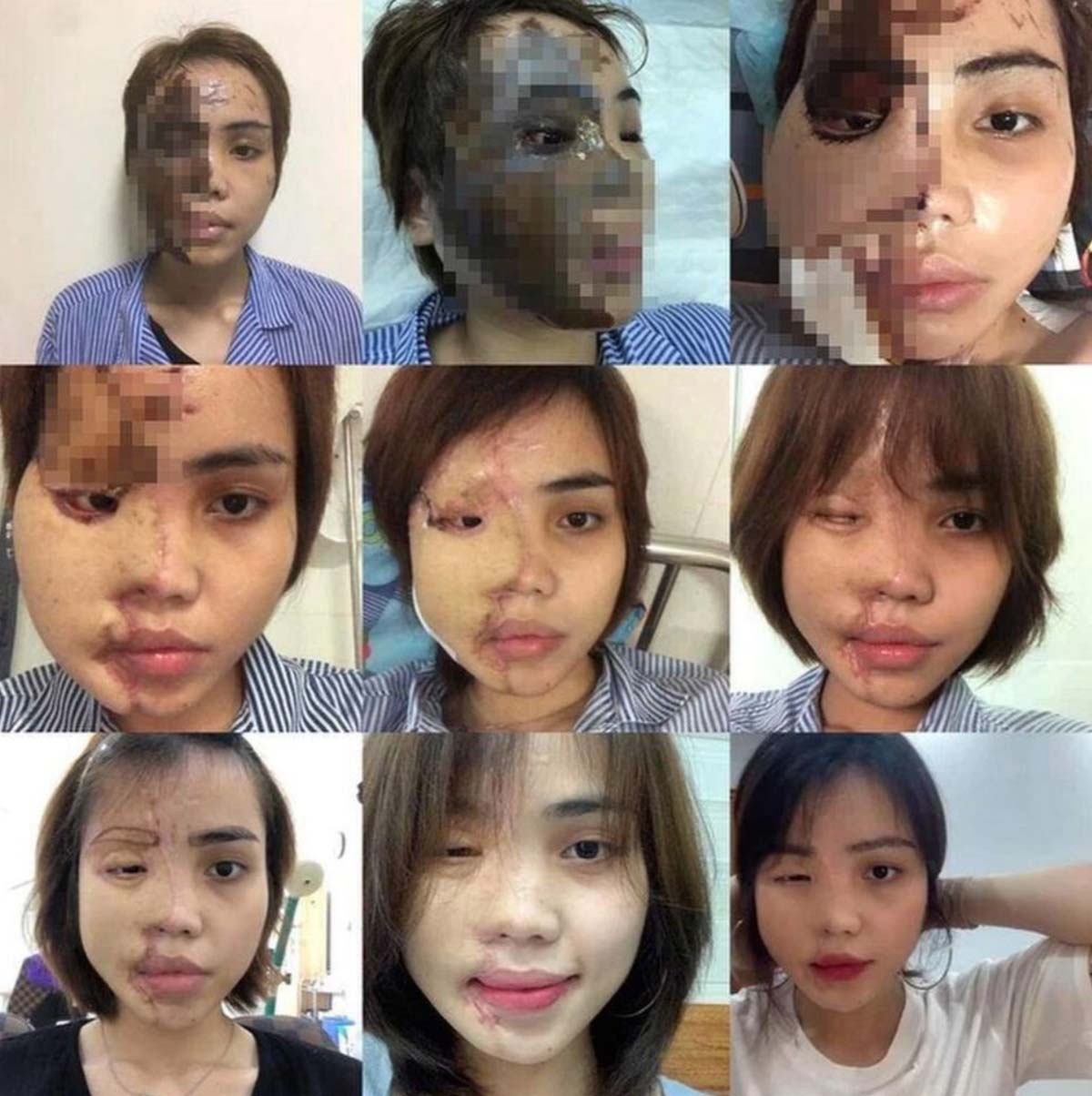 一名25歲的女生因為向未婚夫提出分手而被對方潑硫酸,導致毁容。