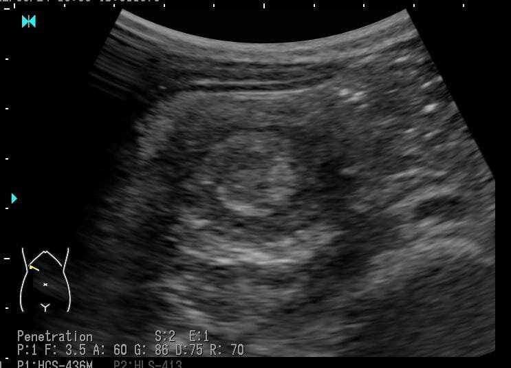 醫生一照超音波，就看到一個像「甜甜圈」的病灶，亦趕緊讓家長帶往急診處理。