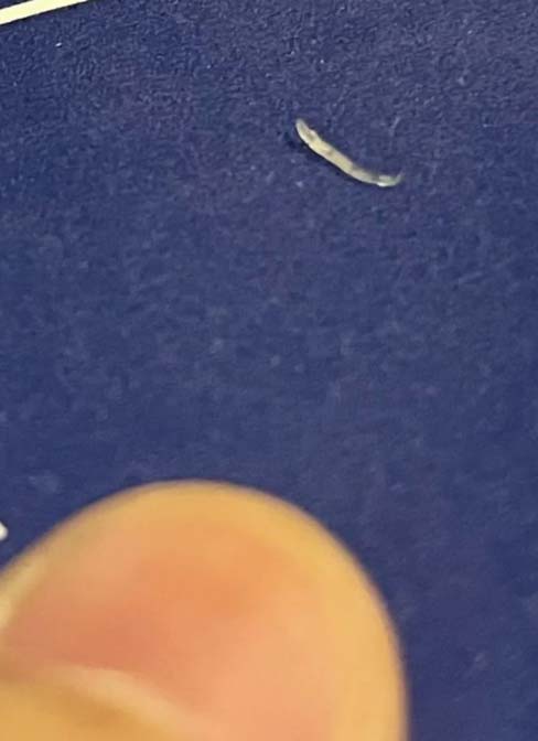 女生再次感覺到肛門處有物體爬出,才再摸到一條生猛蠕動的蟯蟲,最終確診是寄生蟲感染。