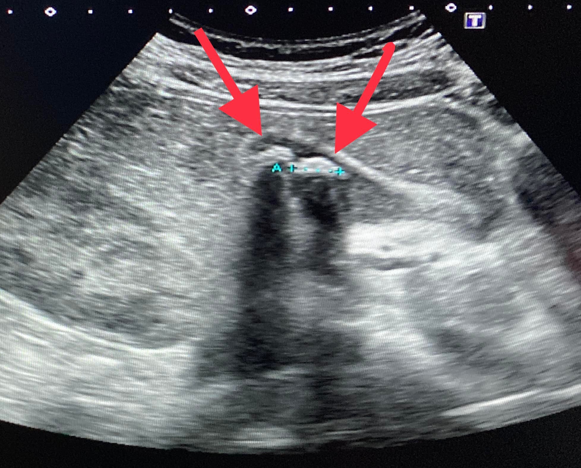 經超聲波檢查,發現該男生的膽囊佈滿膽泥、已經沒有正常的膽汁,且至少有五顆直徑1.2厘米以上的膽結石漂浮其中。