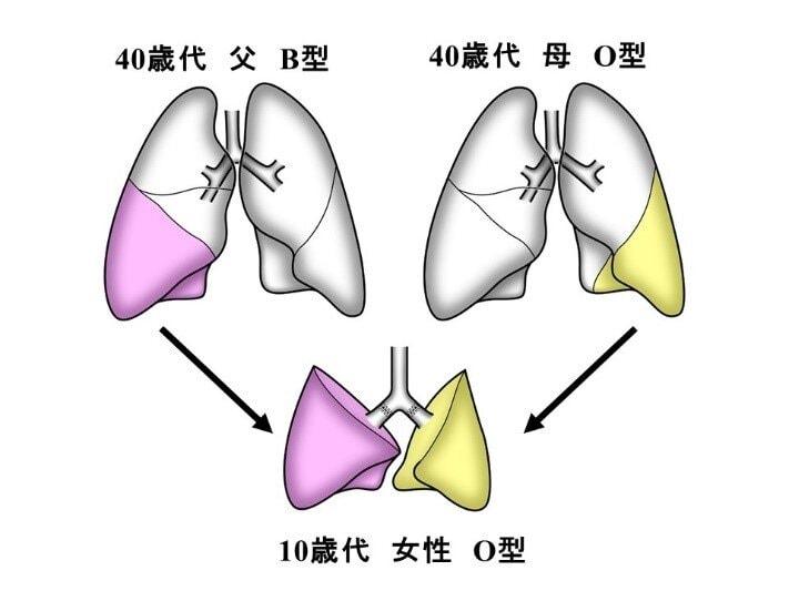 患者父母均為40多歲,母親與患者血型相同,為O型,但父親是B型,屬相異。