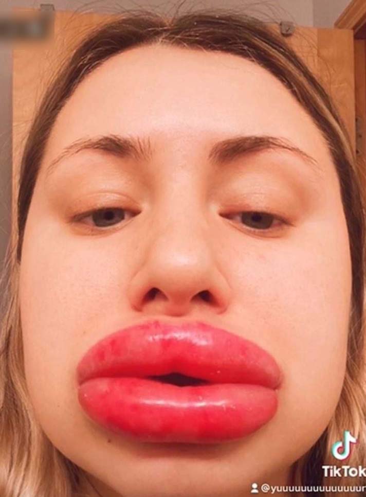 美國23歲女子整容過敏，導致嘴唇腫脹8倍。