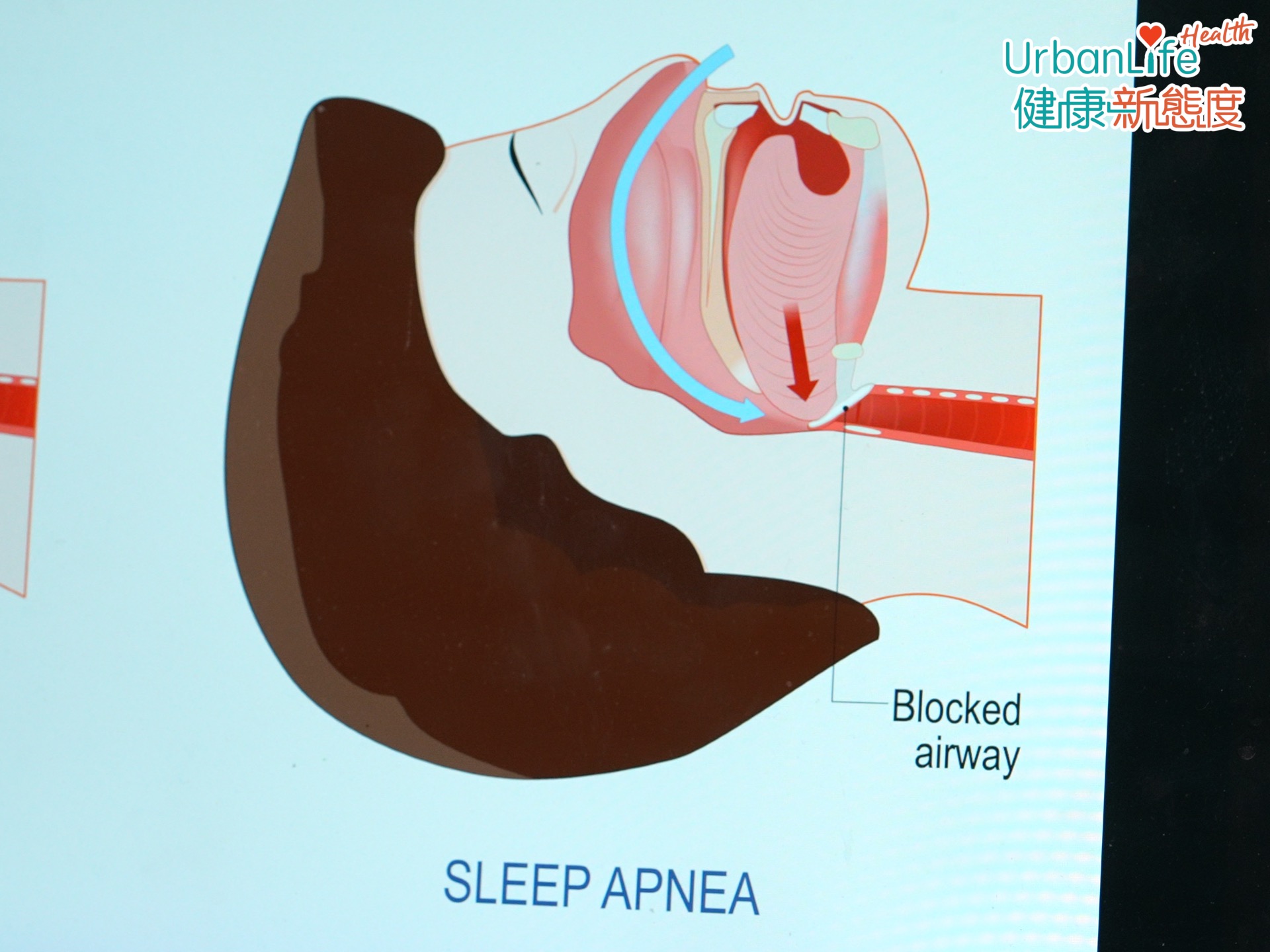 針對阻塞性睡眠窒息症來說,此類型佔了95%睡眠窒息症個案。