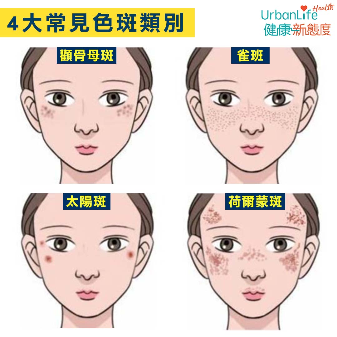 今次分享四種常見色斑的種類、治療方法。