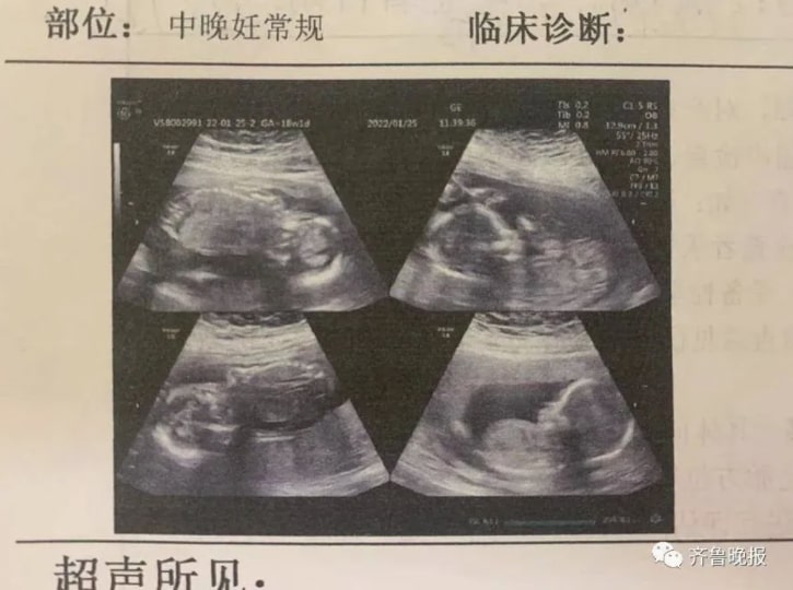 四胞胎超聲波相片。