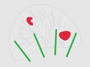 過去,當病人前列腺特異抗原(PSA)水平升高時,醫生會進行系統性活檢,即是在整個前列腺平均地抽取多個核心樣本化驗。
