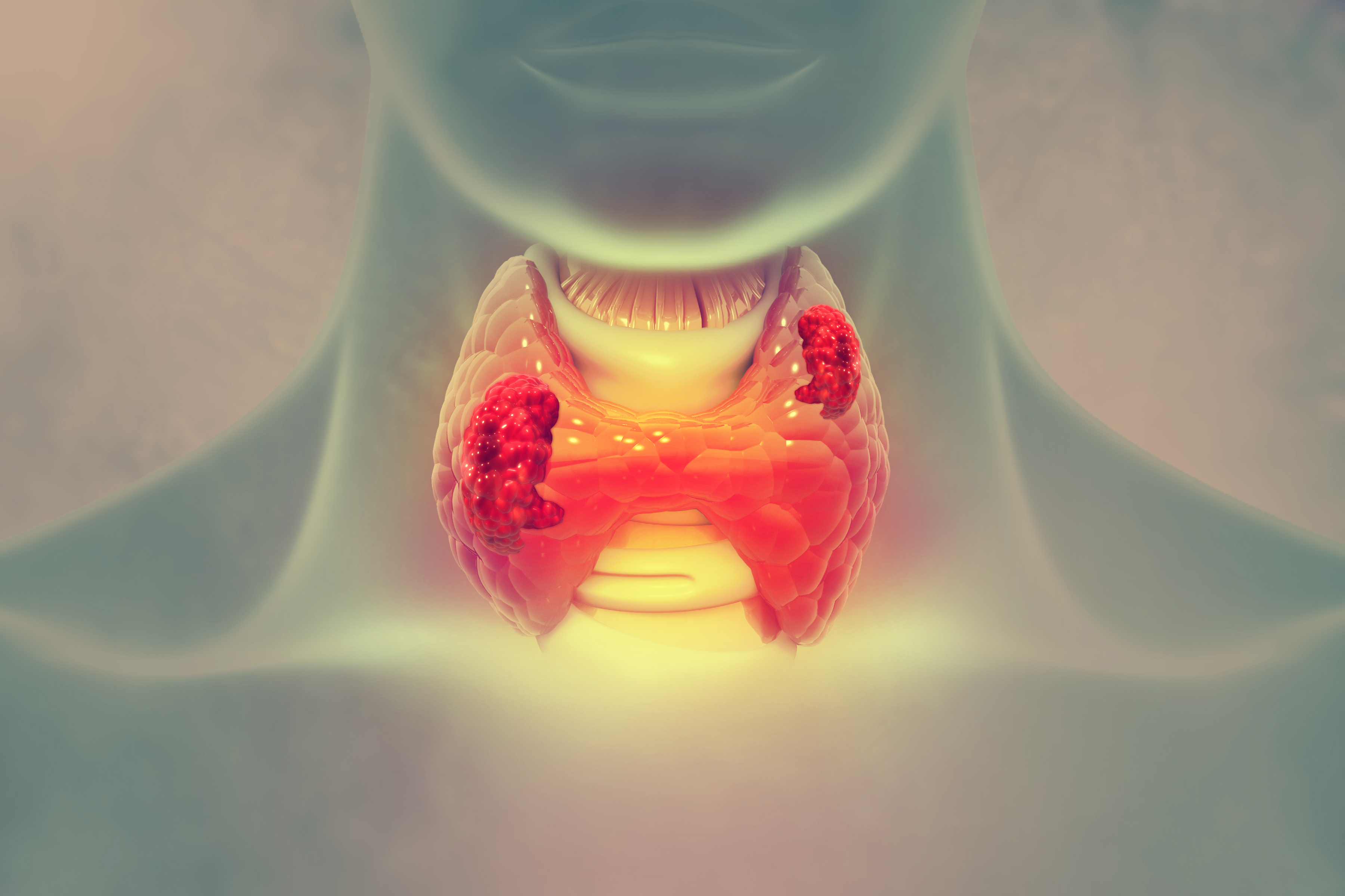 甲狀腺癌(Thyroid Carcinoma)是最常見的甲狀腺惡性腫瘤。