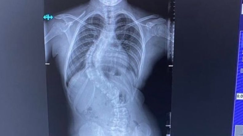 醫生指,針對女孩的情況,已無法透過配戴支架改善,故需做手術。