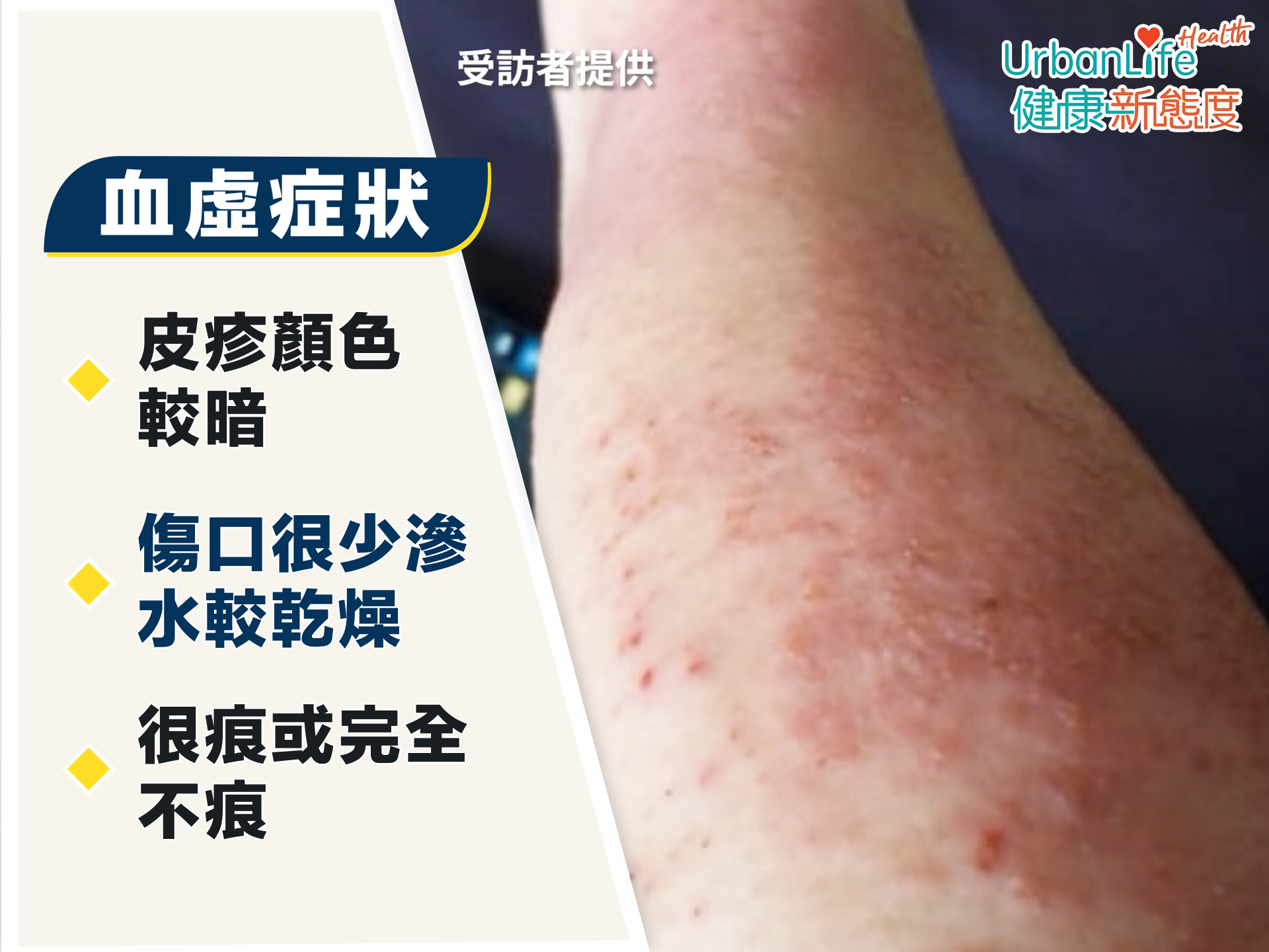 證型三：血虛風燥。