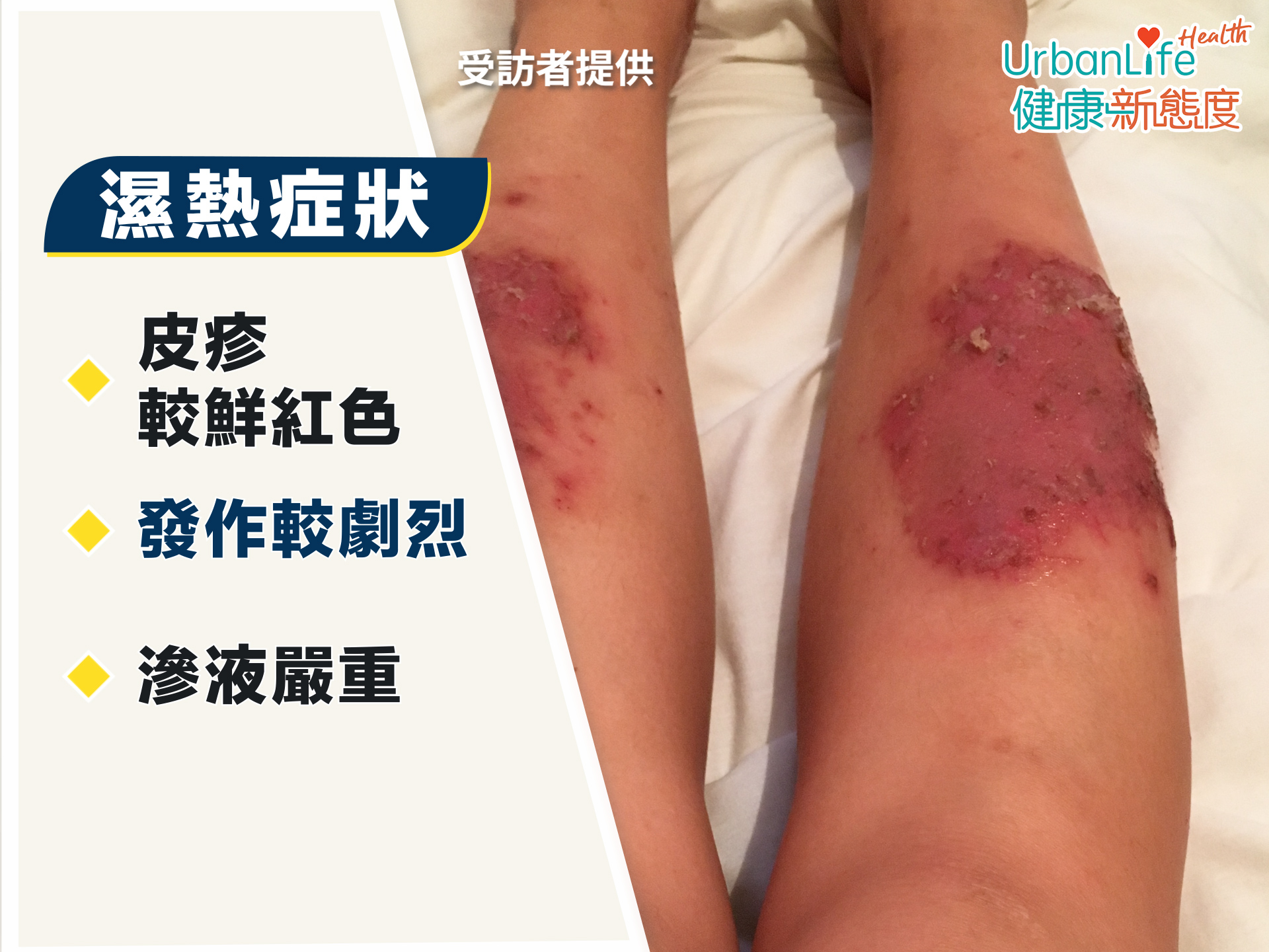 證型一：濕熱蘊結。