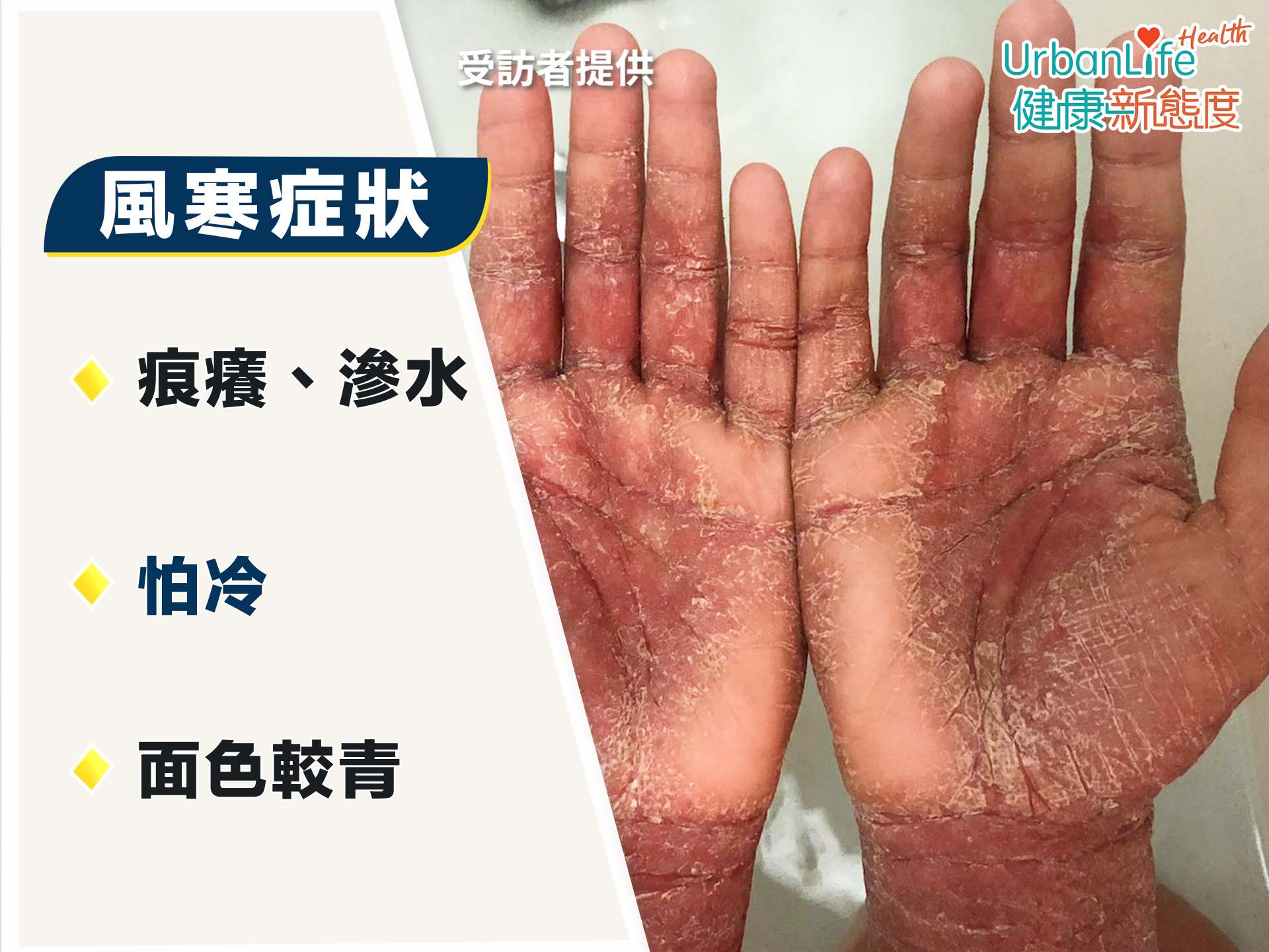 證型四：風寒。