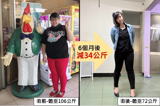台灣34歲女士透過「胃鏡縫胃」手術縮小其胃部容量、降低飢餓感,半年後,從106公斤減到72公斤,成功減重34公斤。