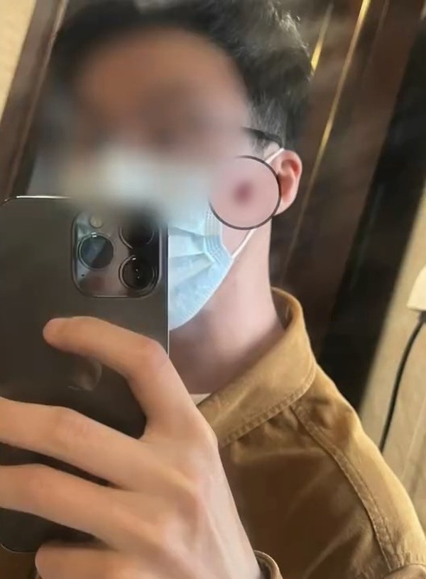 內地一名男子擠破了臉上的暗瘡後，一個月內多次流血不止，求醫後被診斷患上血管瘤，其後需要接受手術治療。