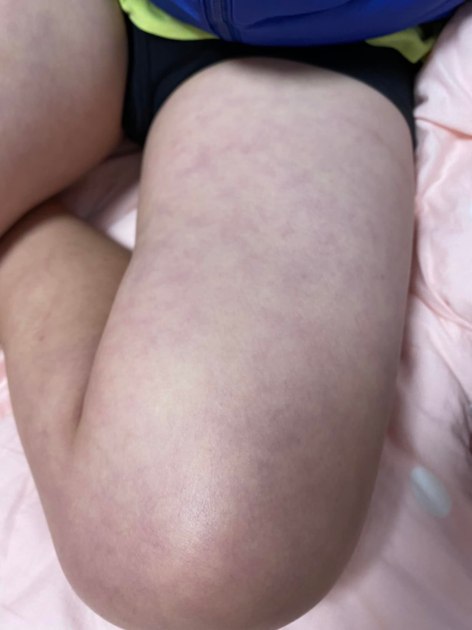 基於孩子全身會因太燒起紅疹,楊小姐表示,亦可準備毛巾,並用冷水將其擰乾、幫助擦拭。