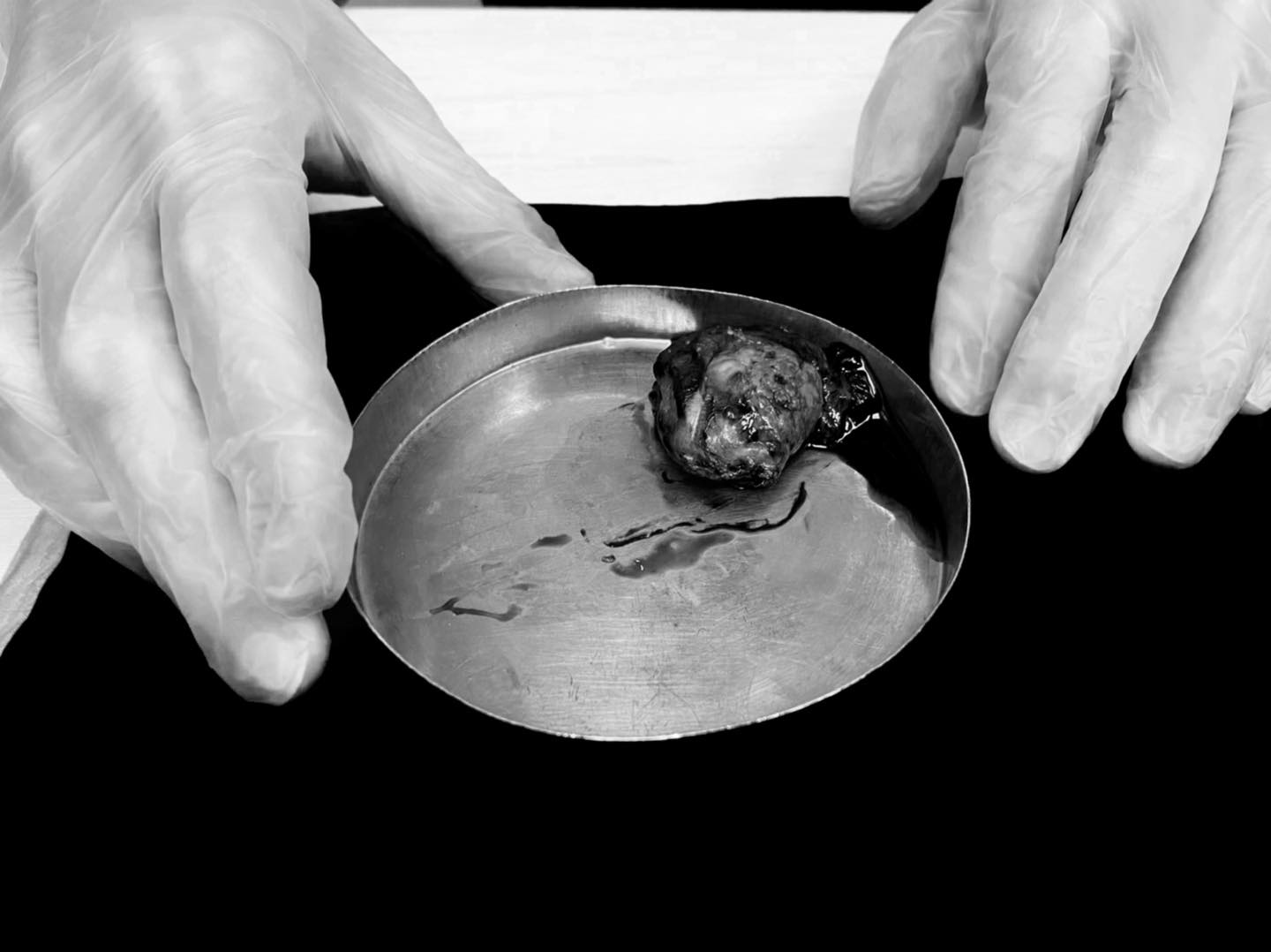 唐玲也公開一個壞消息道:「我那顆腫大的卵巢,檢驗結果是惡性。」