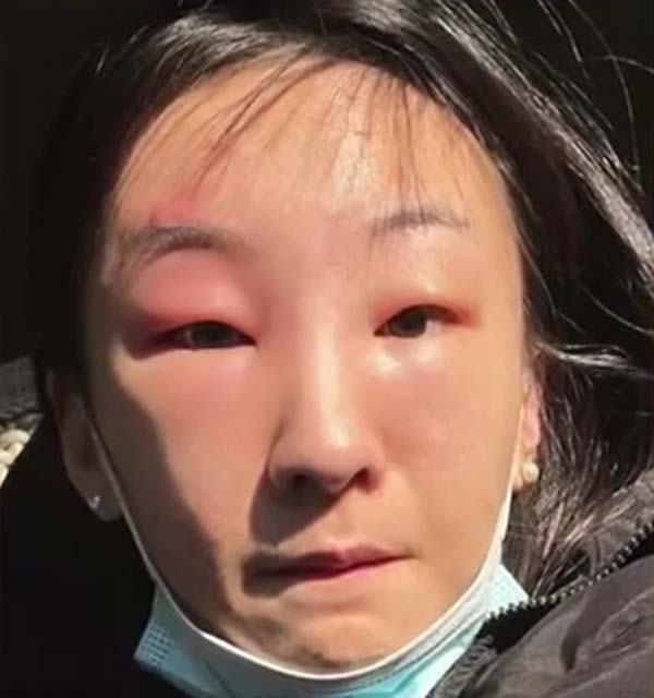 第二天睡醒後發現睜不開眼,整個臉部完全又紅又腫,雙眼眼皮都腫得變成單眼皮。