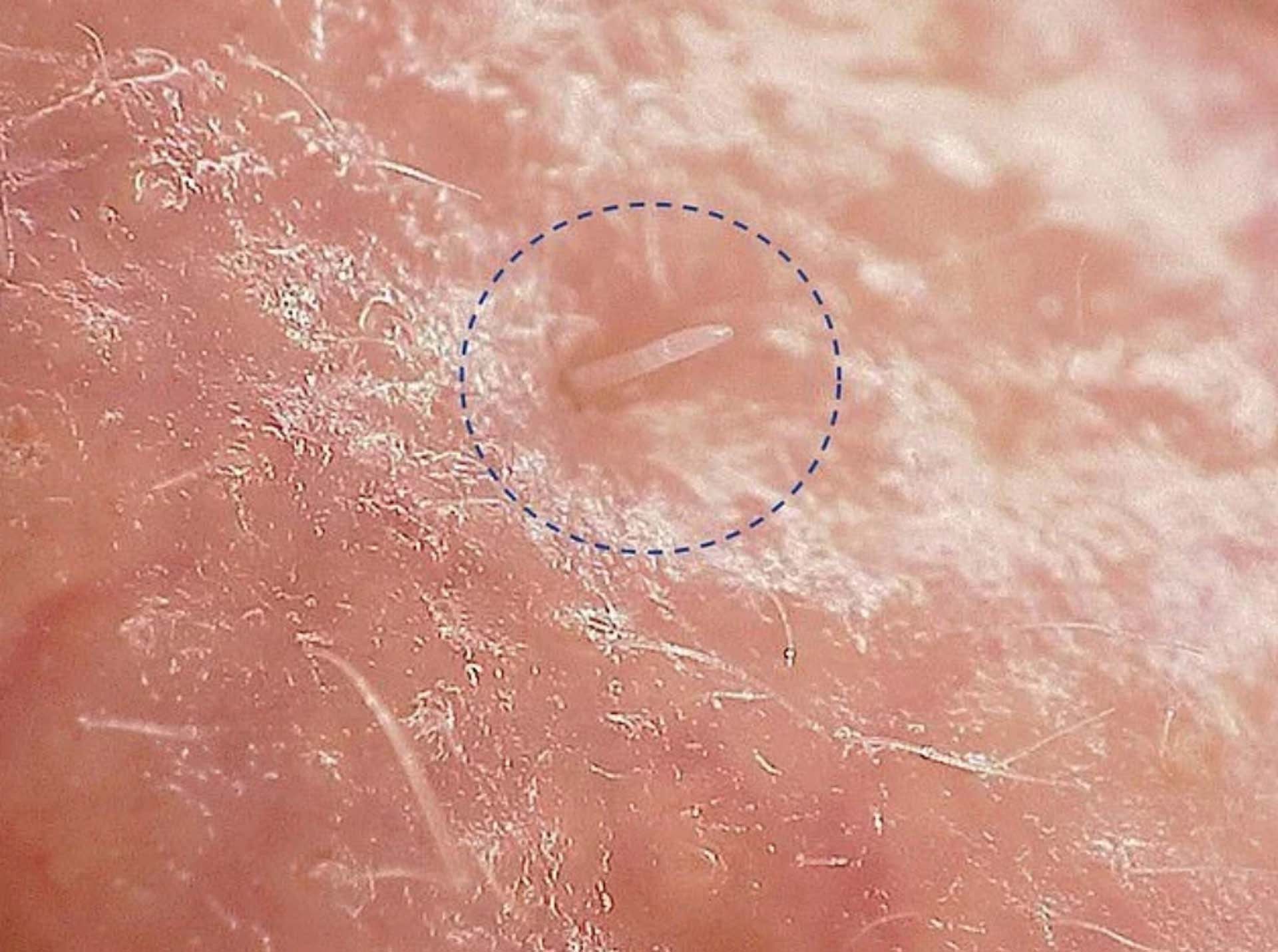 研究發現,人類自幼就會染上「毛囊蠕形蟎」,全球多達90%的人毛孔中都存在蠕形蟎蟲。
