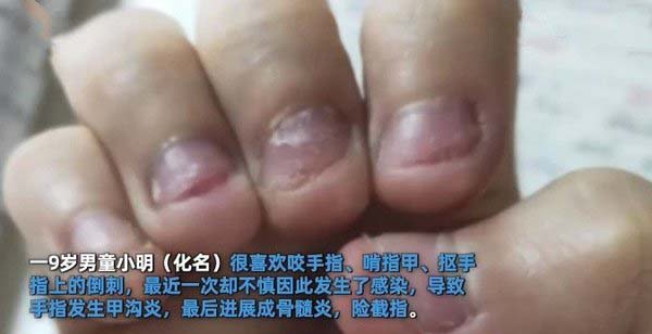 醫生指小明食指已演變成骨髓炎,可能需要截指保命。