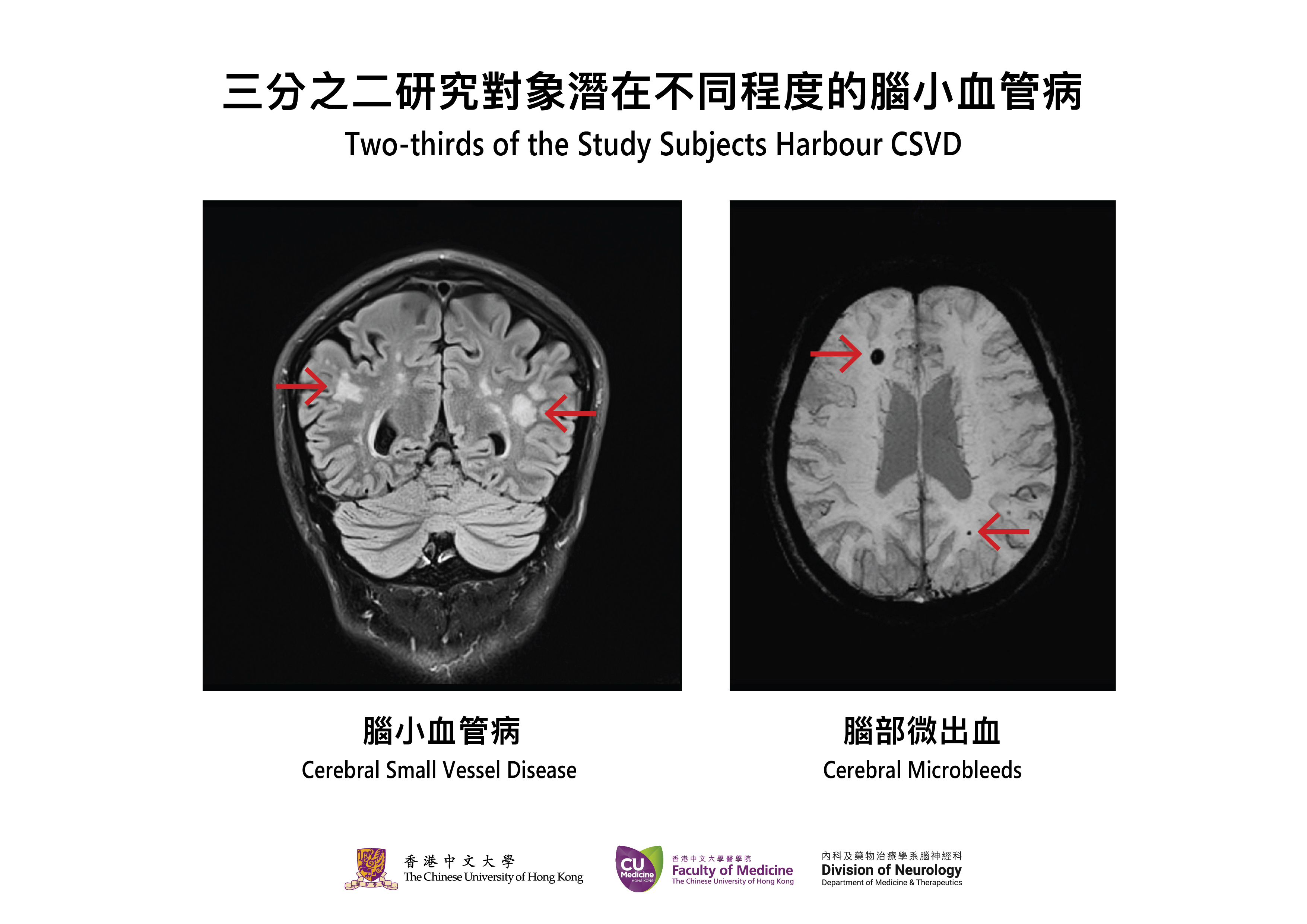 腦小血管病是中風及認知障礙症的主要成因，目前可透過影像檢查發現病變。