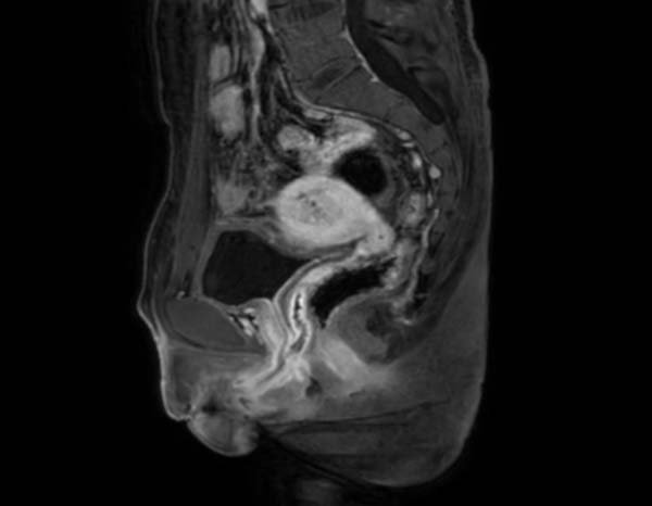 男子被告知自己的染色體性別竟是女性,而一直有的腹痛及血尿問題其實就是月經來潮所導致的。