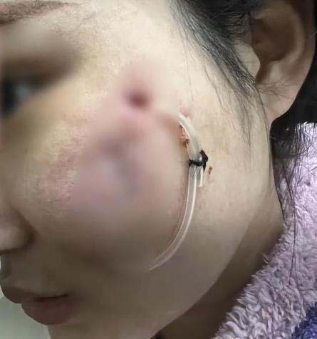 醫生為陳女士進行詳細檢查後，發現是細菌感染。