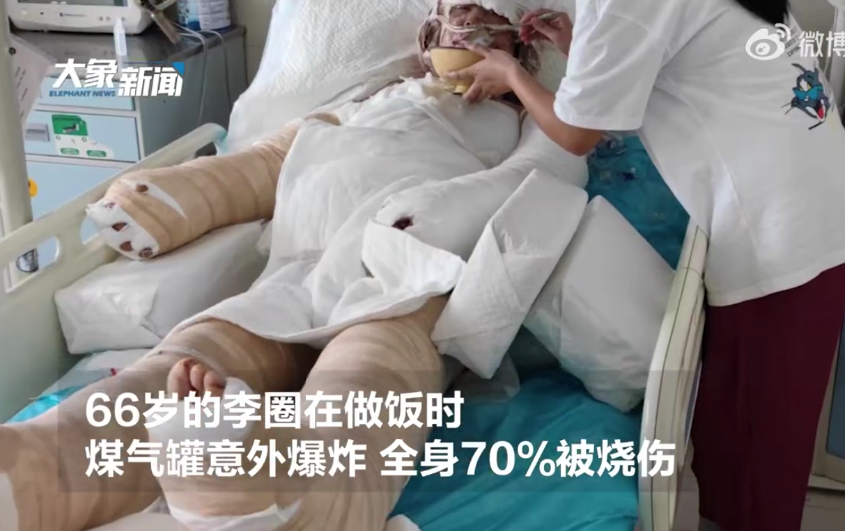 河南一名66歲父親李圈，日前在做飯時，瓦斯罐不慎爆炸，導致全身七成燒傷。