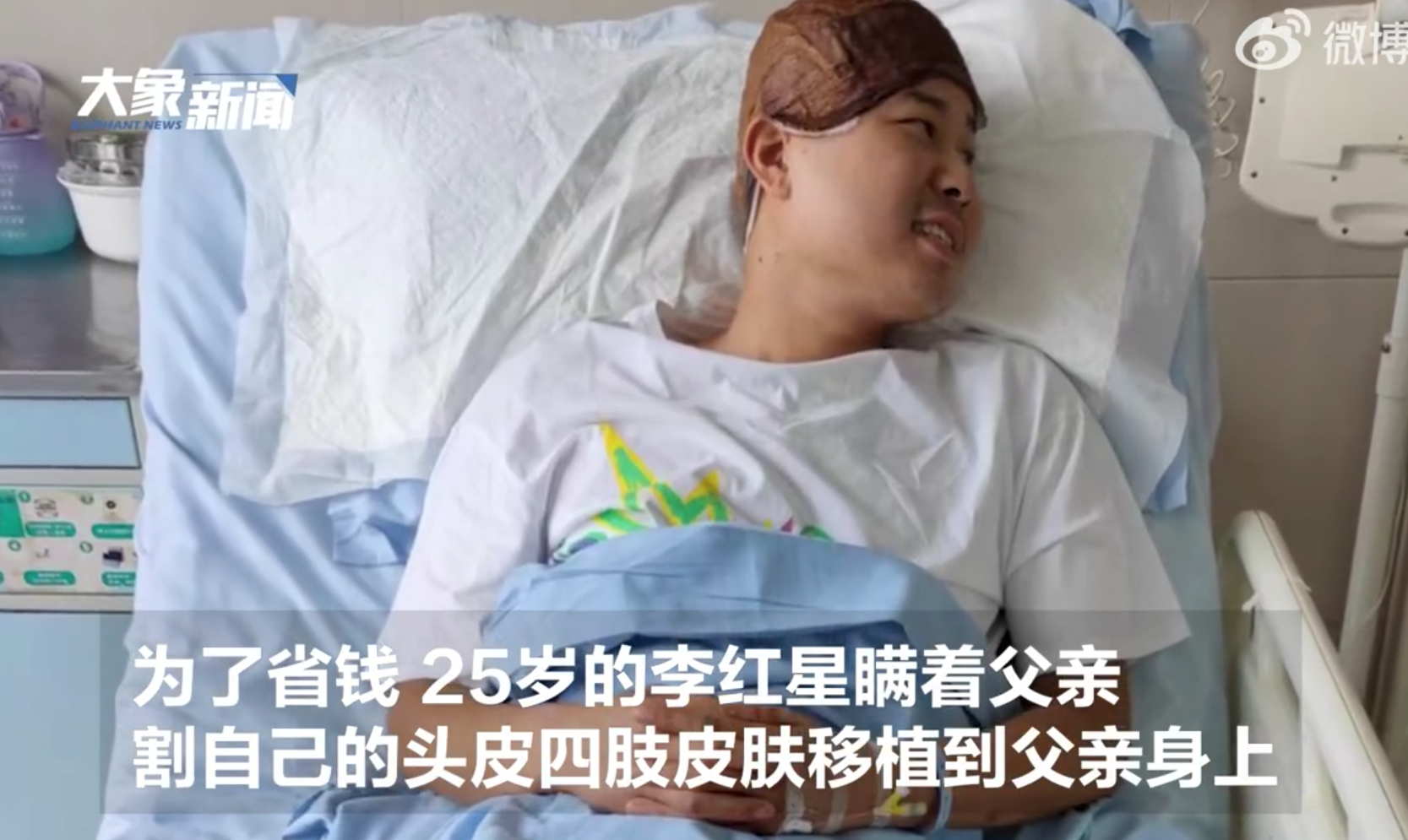 李紅星瞞著父親，偷偷跟醫生商量，割自己的頭皮和四肢皮膚移植到父親身上。