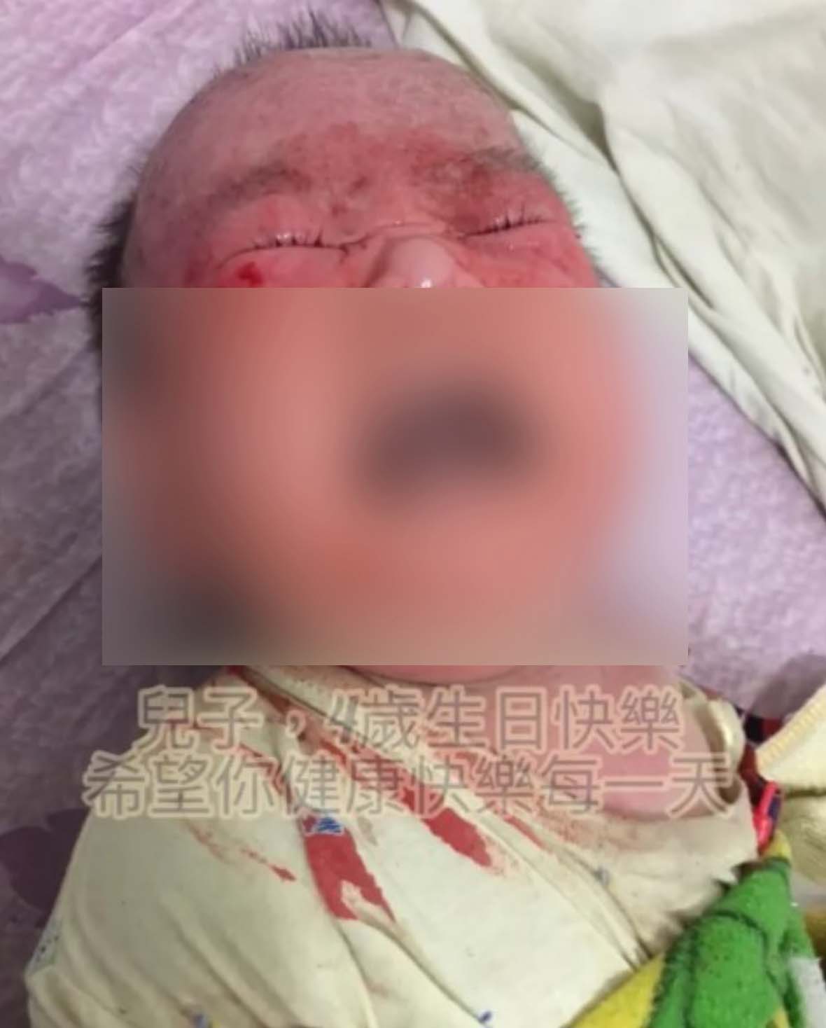 台灣一名媽媽王莘妤在過去4年經歷了一段辛酸的日子，她的二兒子患有「異位性皮膚炎」，先天性缺乏免疫球蛋白。