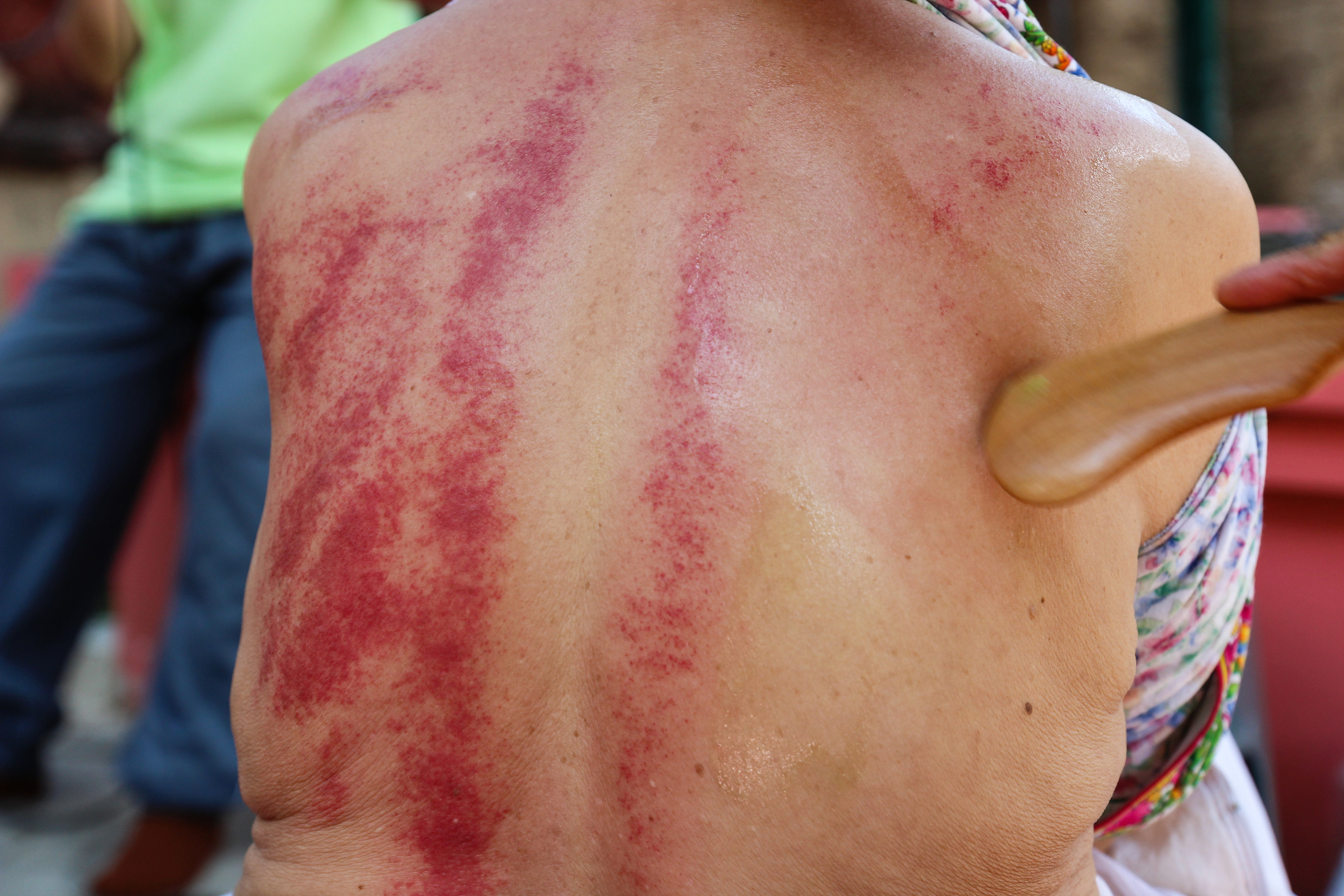 長新冠或因外邪未清,患者刮痧時會「一刮就起痧」。(示意圖,非當事人)