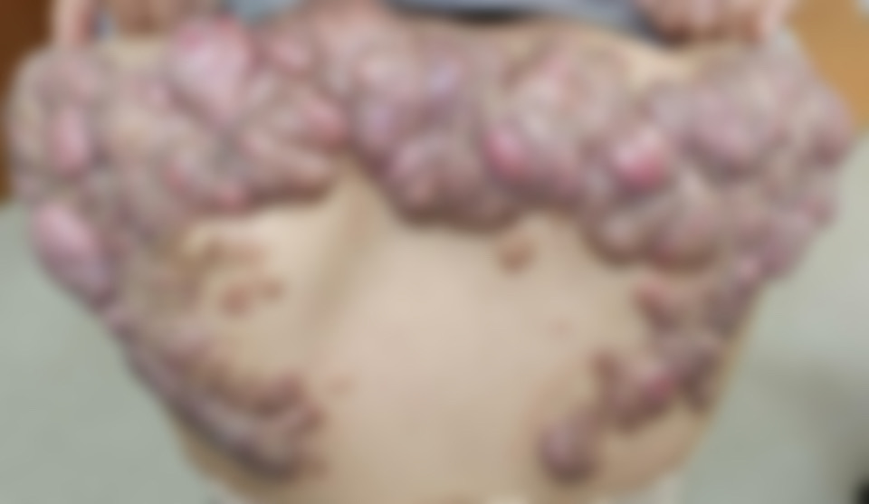 女子背後長半公斤「巨蟲」蟹足腫