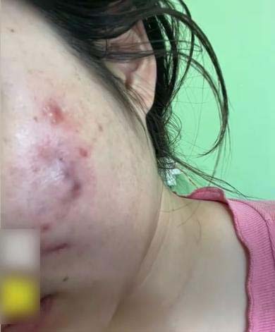 內地女子花2,000元人民幣打美容針，慘變毀容。