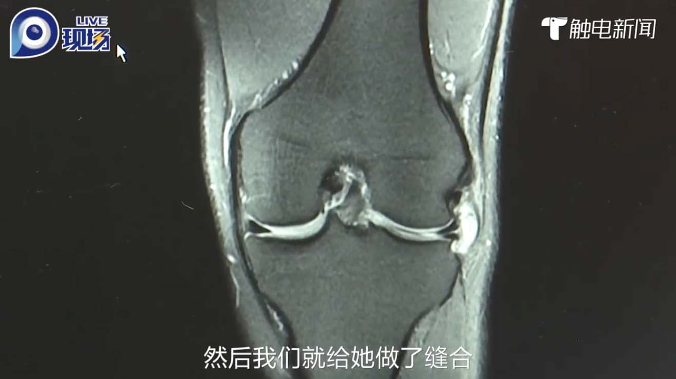 經詳細檢查後,醫生診斷黃女士患有半月板嚴重損傷。幸好經過適當治療後並沒有大礙。