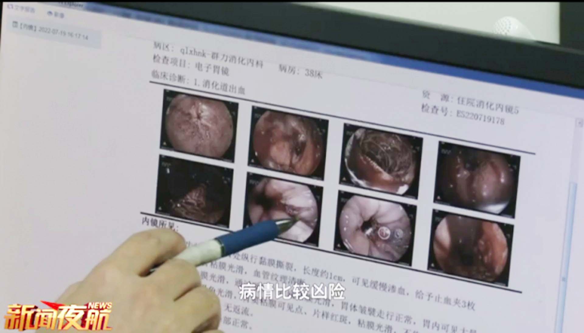 要根據個人的情況減少進食量和減慢進食速度，避免令內臟受到過強刺激。