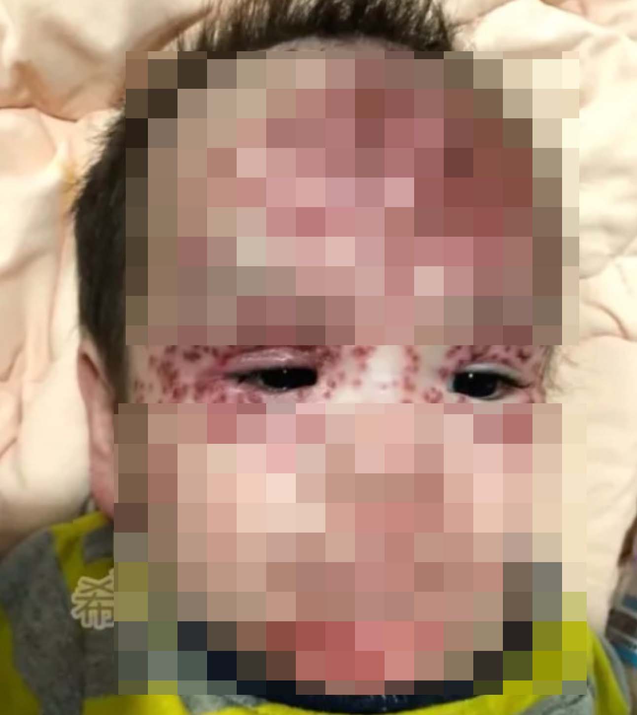 面部腫到看不見眼睛。