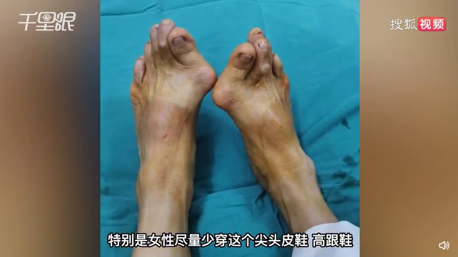 內地一名女子,因愛穿高踭鞋和尖頭鞋,導致拇趾嚴重外翻。