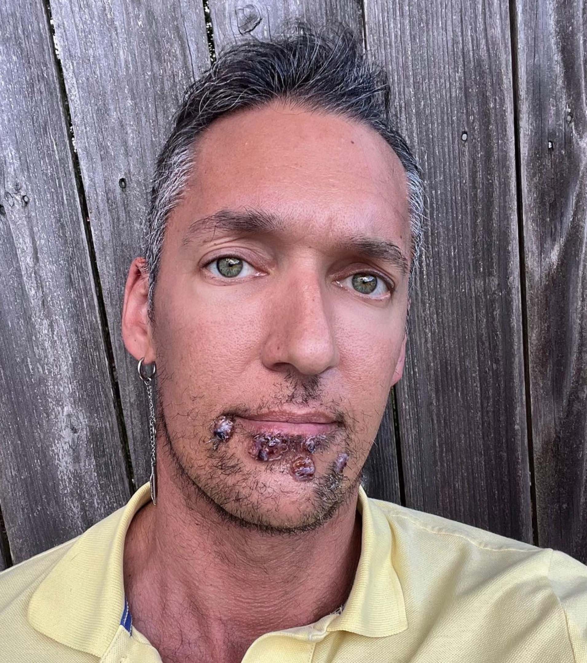 Silver表示,每個人的猴痘症狀都不同,而他的感染位置主要出現在下巴及嘴唇周圍。
