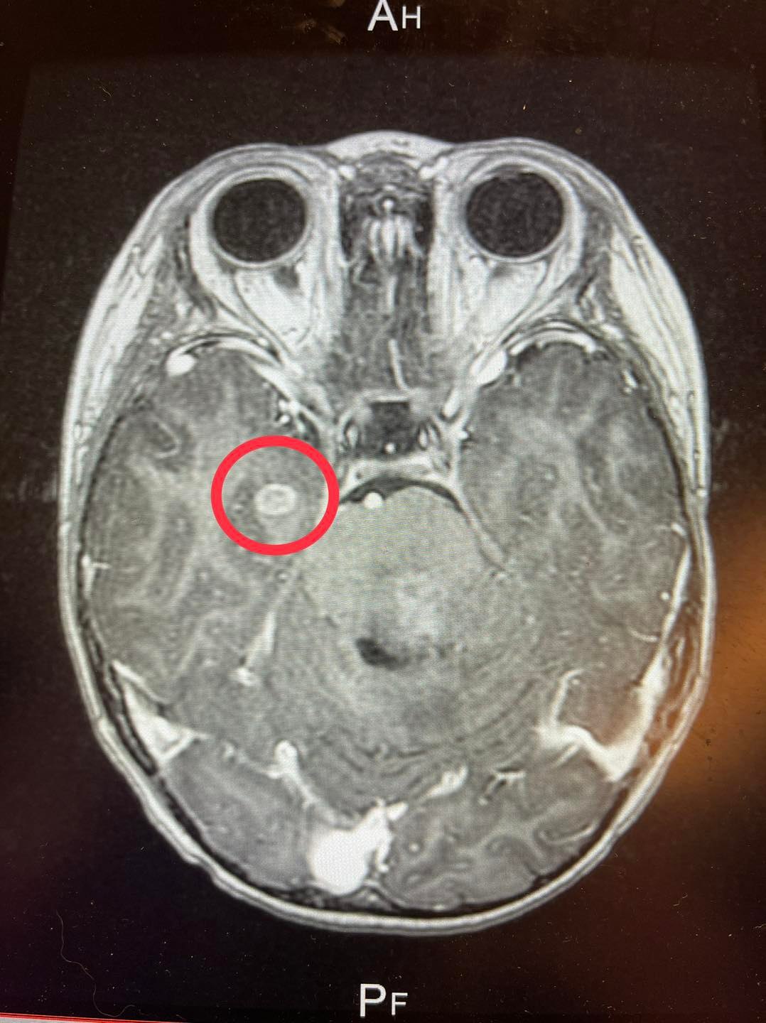 診斷發現兒子晨翔的腦幹有個約6厘米大的陰影。