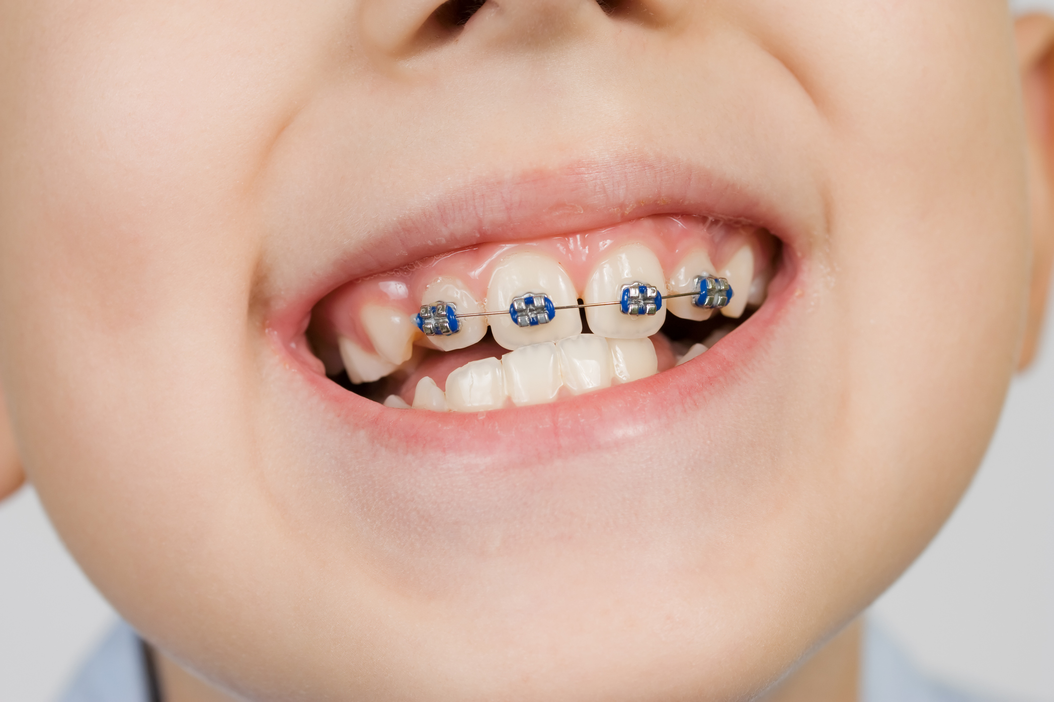braces