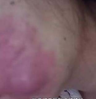 經醫生診斷後,證實陳女士患上表皮囊腫,最終需做手術將囊腫取出。