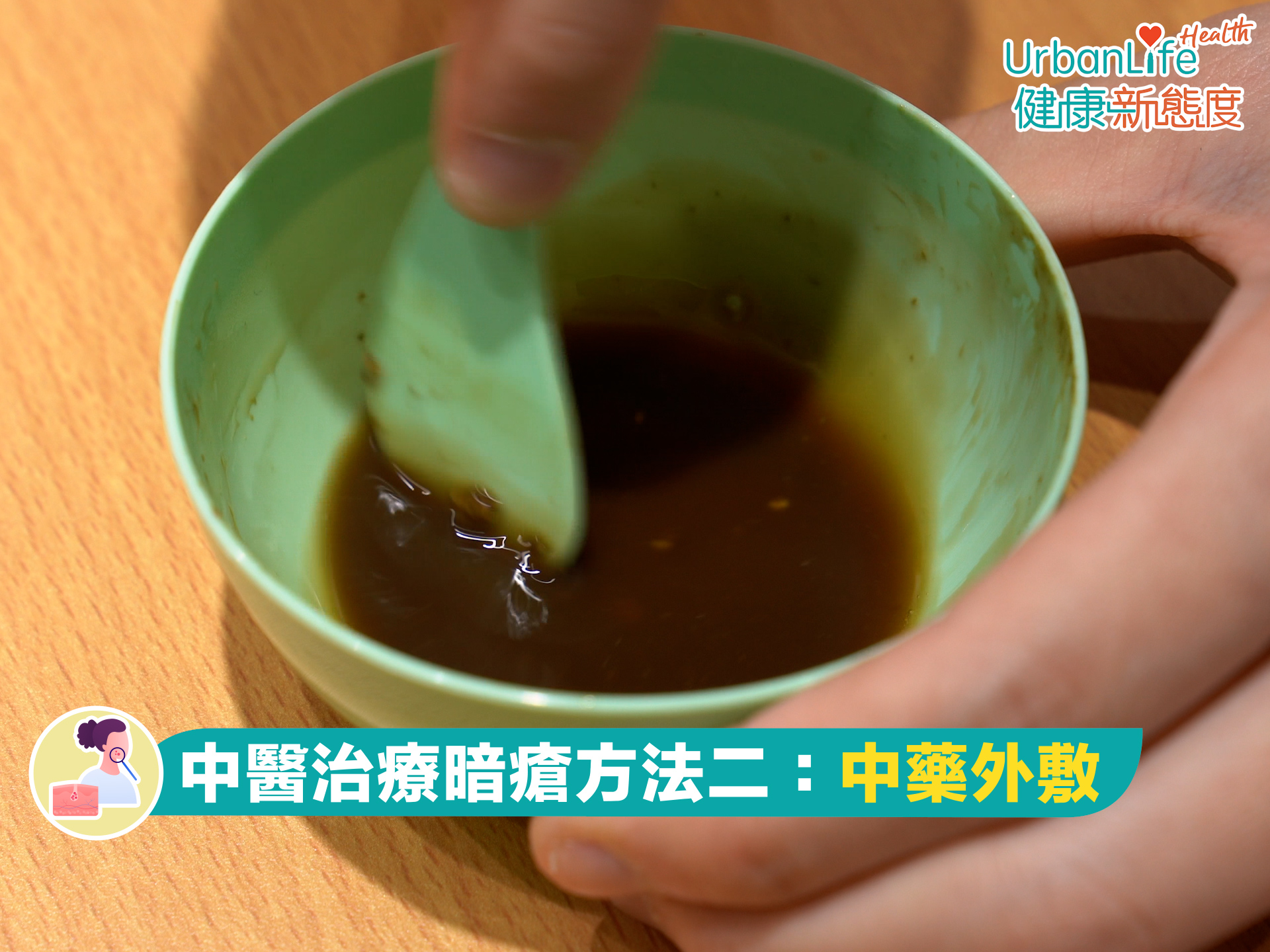 中醫面膜、藥膏可促進暗瘡傷口癒合。