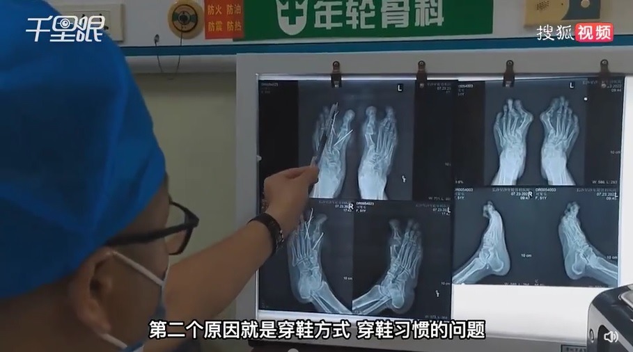 王女士雙腳拇趾外翻45度,而其他腳趾亦陸續變得畸形。