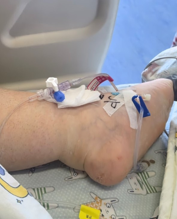 「小胖威利綜合徵」是一種罕見的先天性疾病。