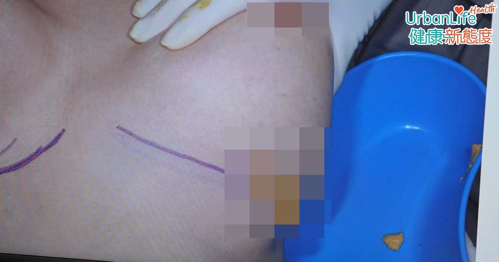 注射PAAG後，不會被吸收、不會被分解，或會引致發炎、含膿。