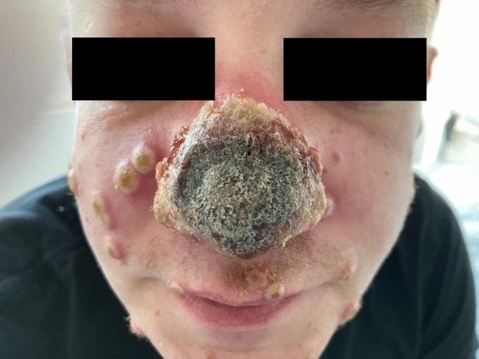 男子其後爛鼻發黑腫脹,身上亦開始出現膿皰,並滲出白色液體。